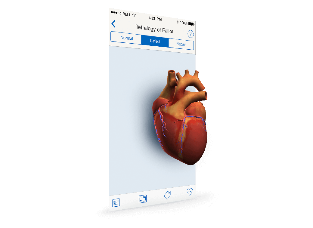 Visualize heart defects with a clear explanation Rendering of smart phone displaying application